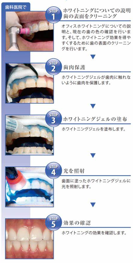 オフィス ホワイトニングの説明