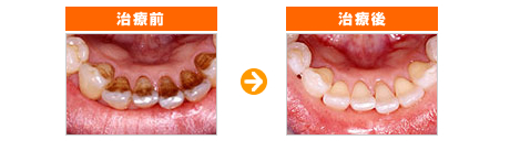 歯のクリーニング