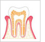 初期（歯肉炎）～中程度（歯肉炎）