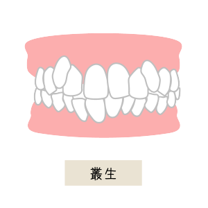 叢生（八重歯、前歯のでこぼこ，乱ぐい歯）